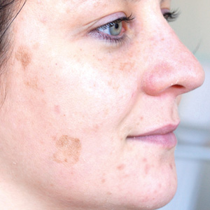 Pigment spots after a GREEN PEEL herbal peeling