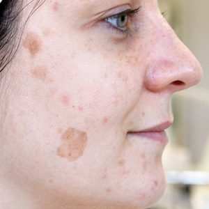 Pigment spots before a GREEN PEEL herbal peeling